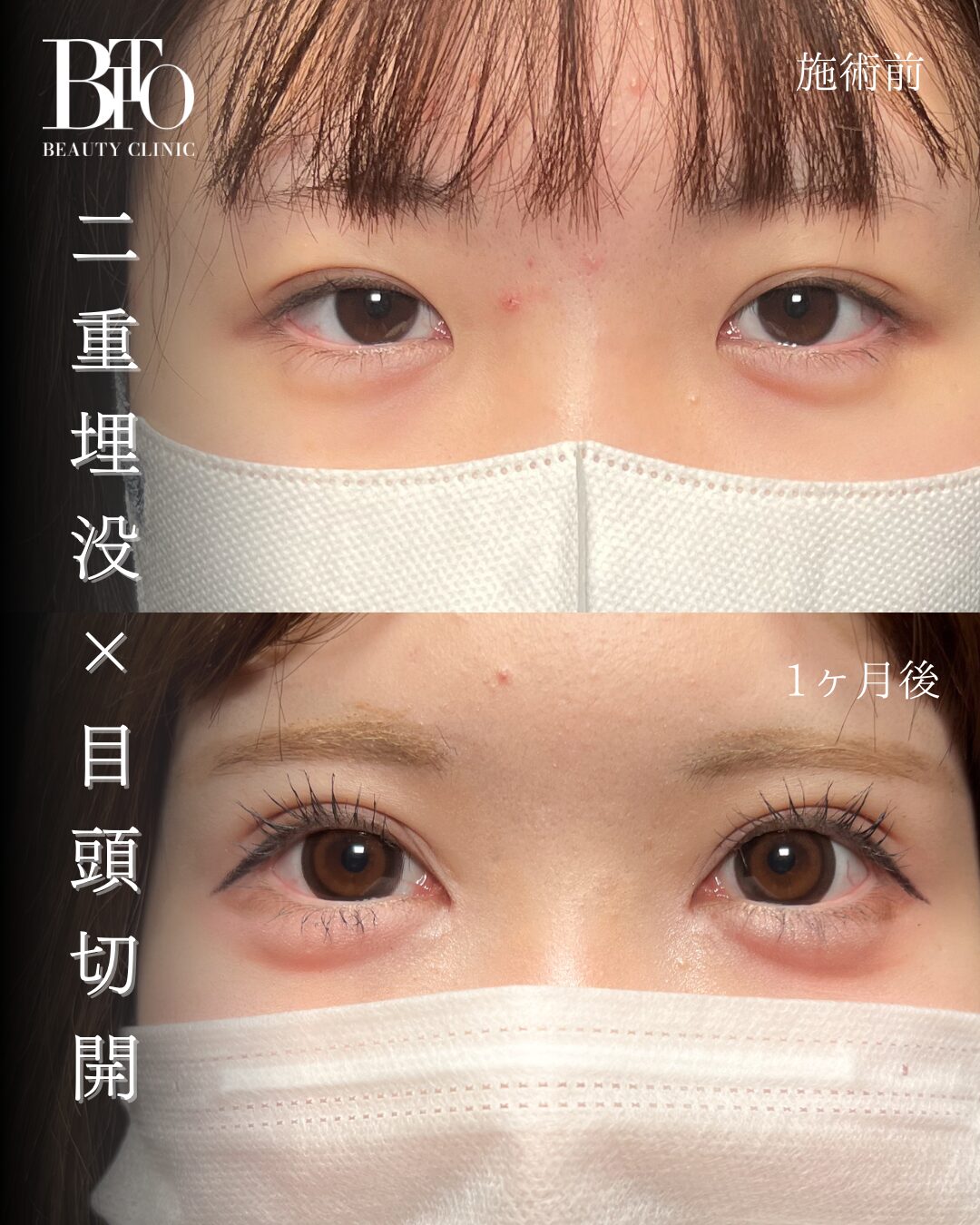 186.20代女性 二重埋没・目頭切開