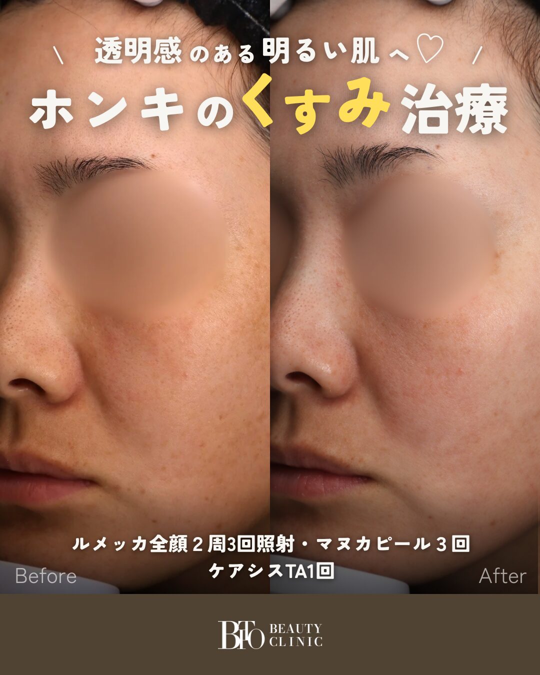 179.ルメッカ,マヌカピール,ケアシス