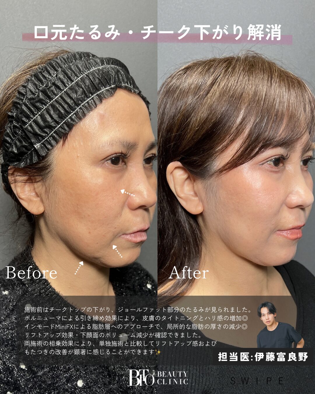 188.50代女性 ボルニューマ・インモード