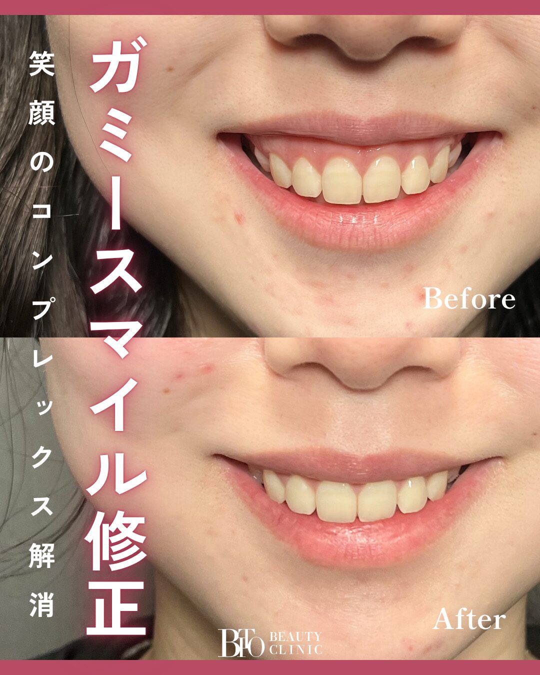 204.20代女性 ガミースマイル修正