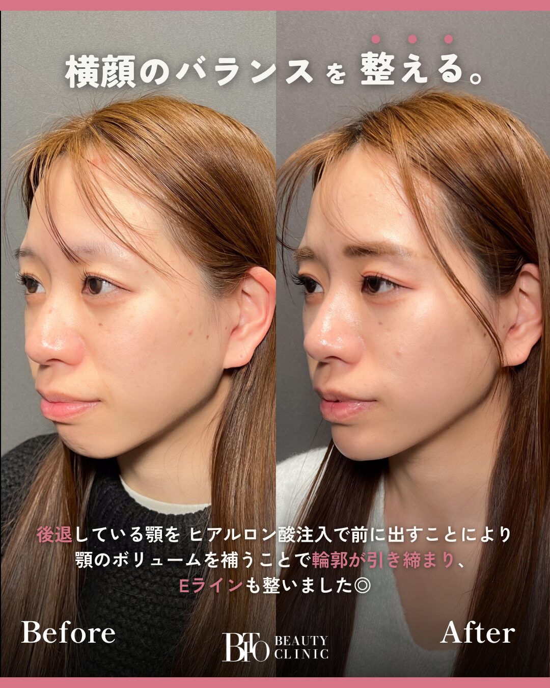 193.顎のヒアルロン酸注射