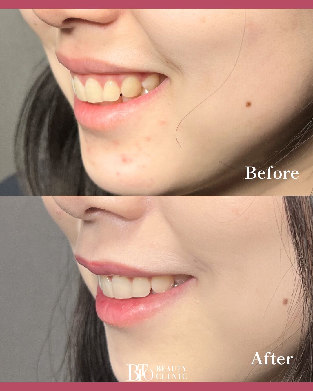 204.20代女性 ガミースマイル修正