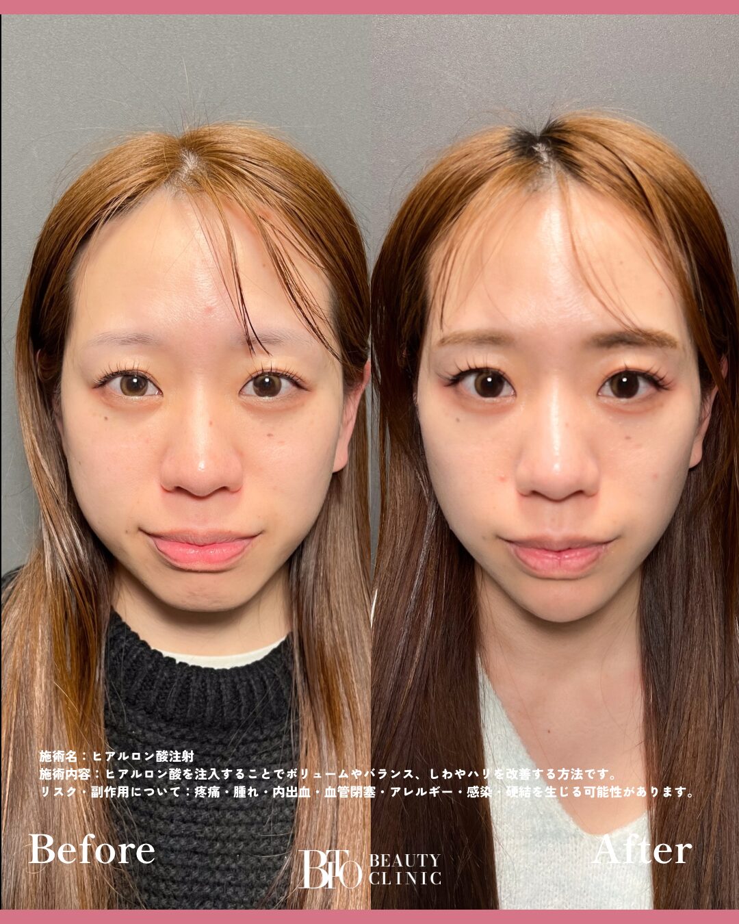 193.顎のヒアルロン酸注射