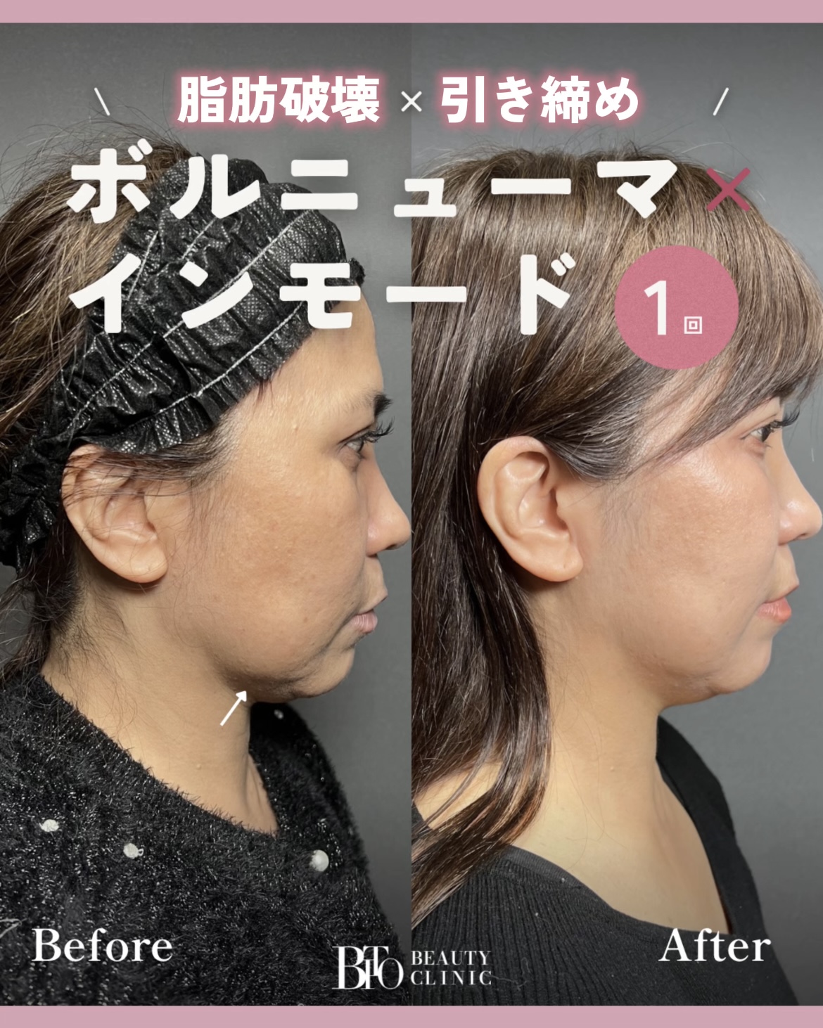 188.50代女性 ボルニューマ・インモード