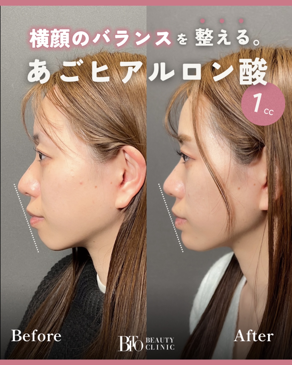 193.顎のヒアルロン酸注射