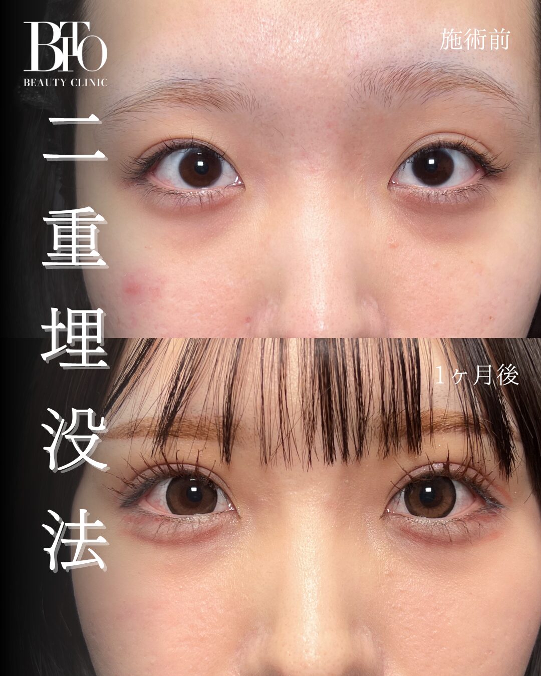 197.20代女性 二重埋没法