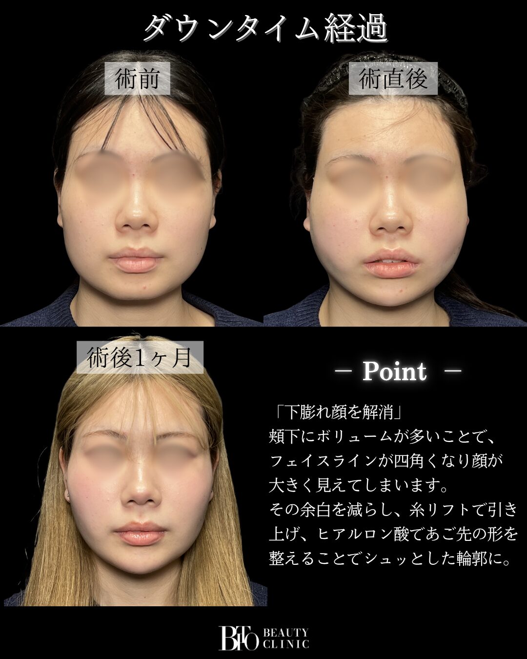 192.10代女性 顔のLSSA脂肪吸引・バッカルファット除去・糸リフト・ヒアルロン酸