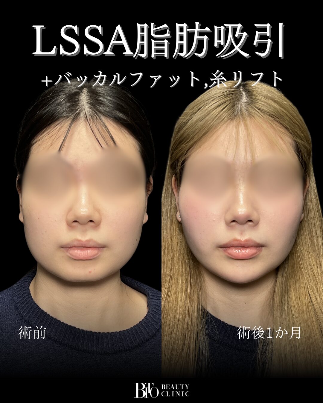 192.10代女性 顔のLSSA脂肪吸引・バッカルファット除去・糸リフト・ヒアルロン酸