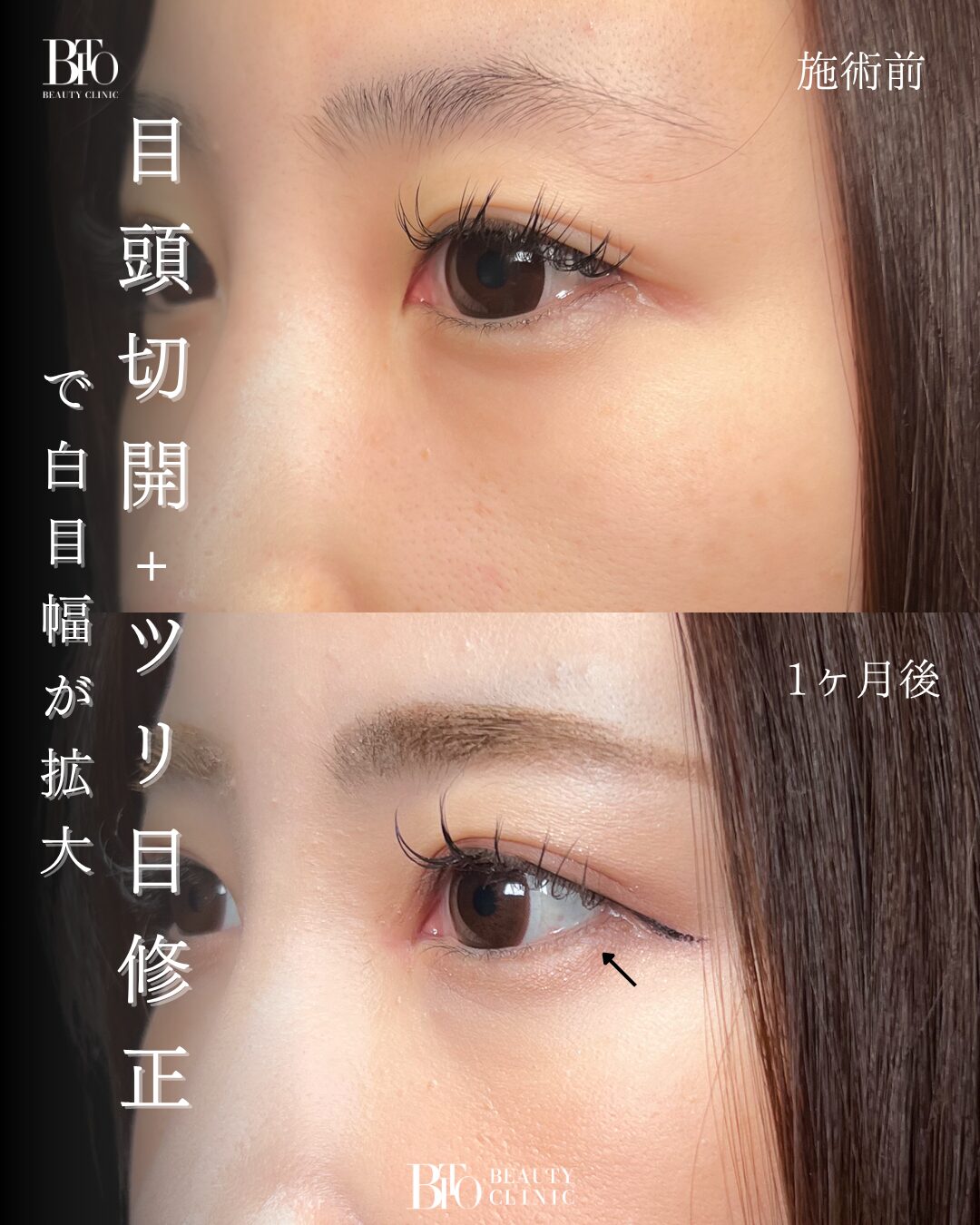 187.30代女性 グラマラスライン形成(埋没)