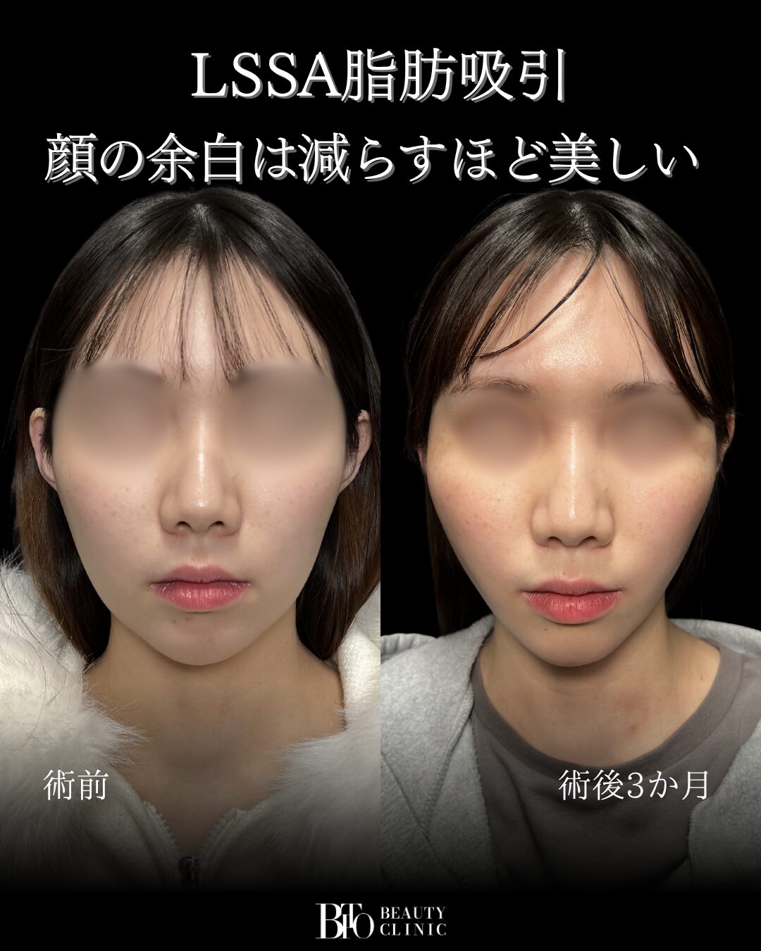218.顔のLSSA脂肪吸引