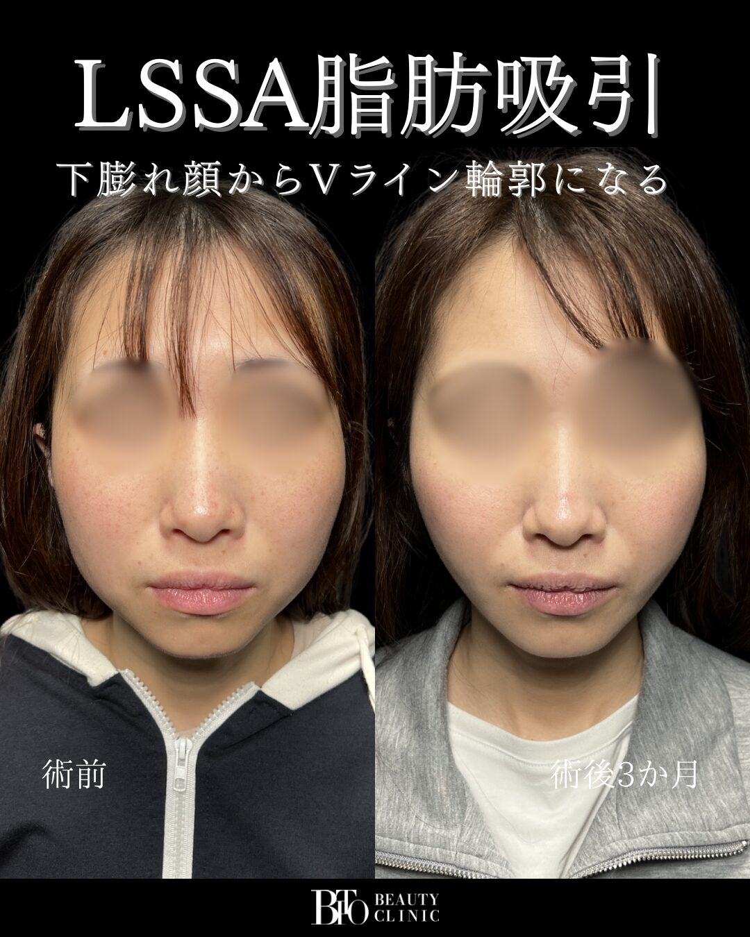 210.顔のLSSA脂肪吸引