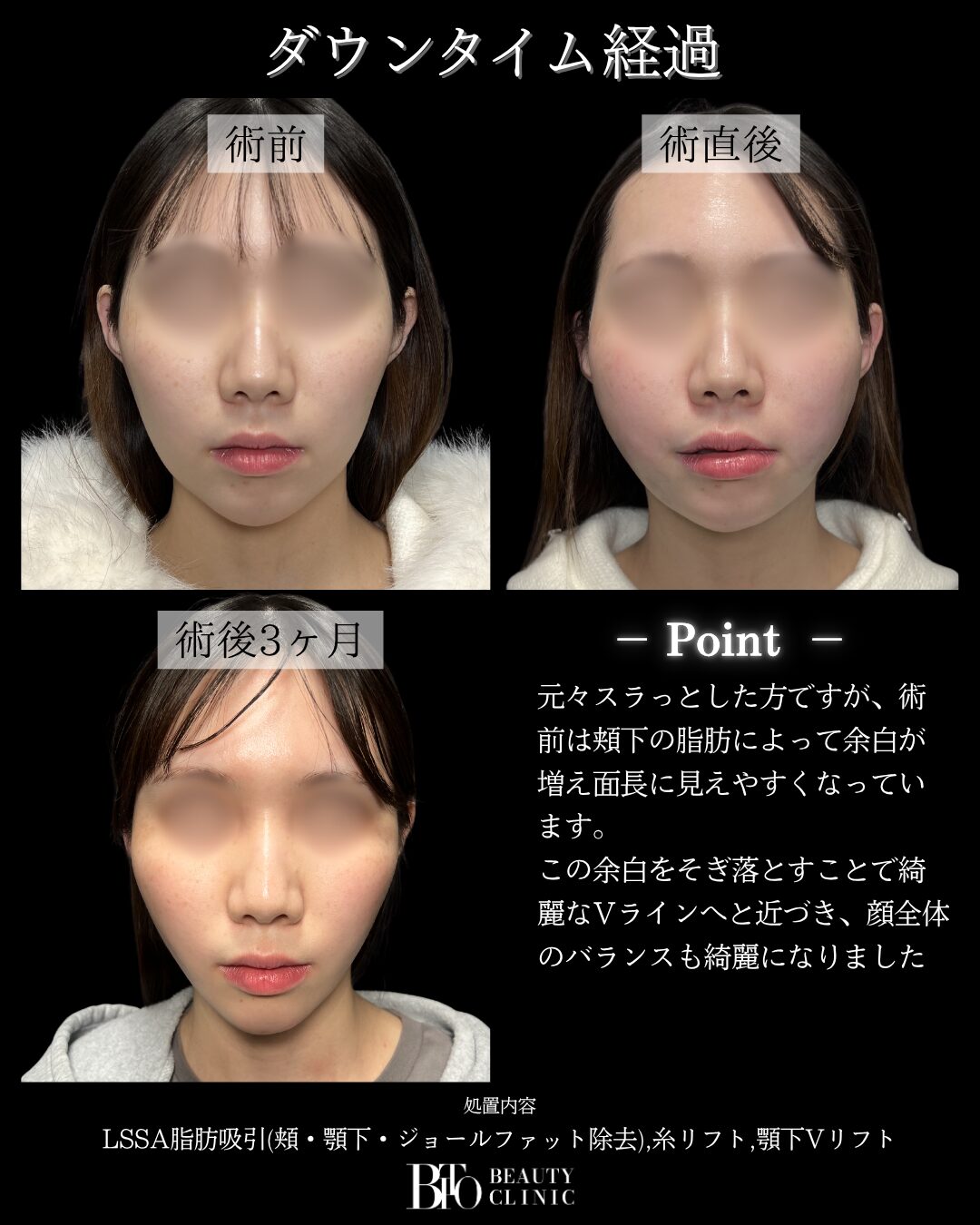 218.顔のLSSA脂肪吸引
