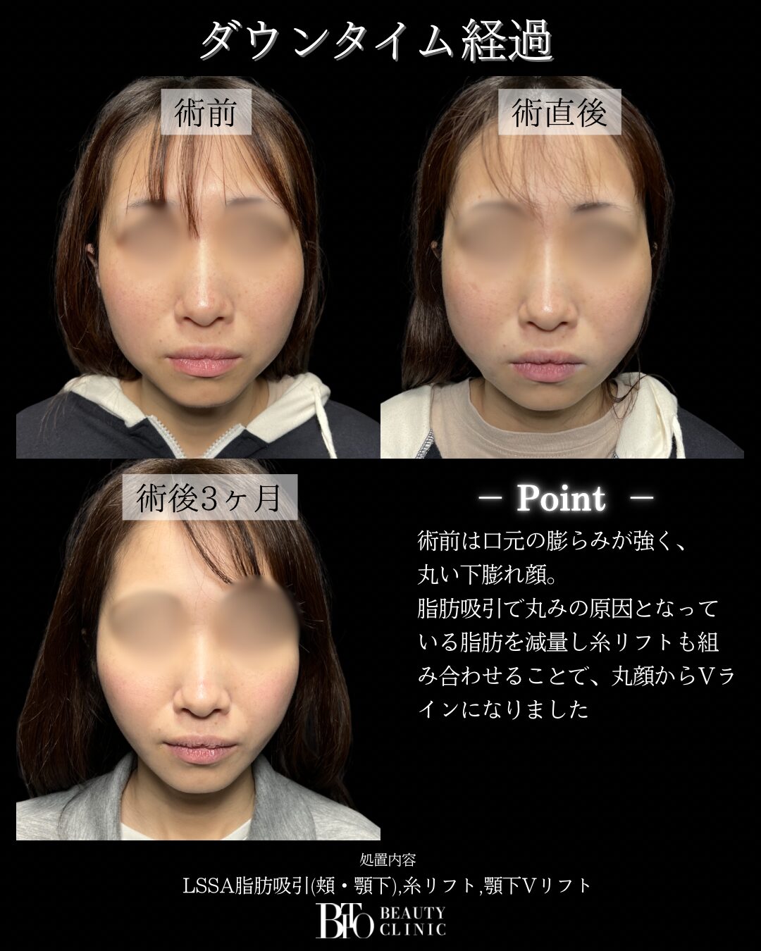 210.顔のLSSA脂肪吸引