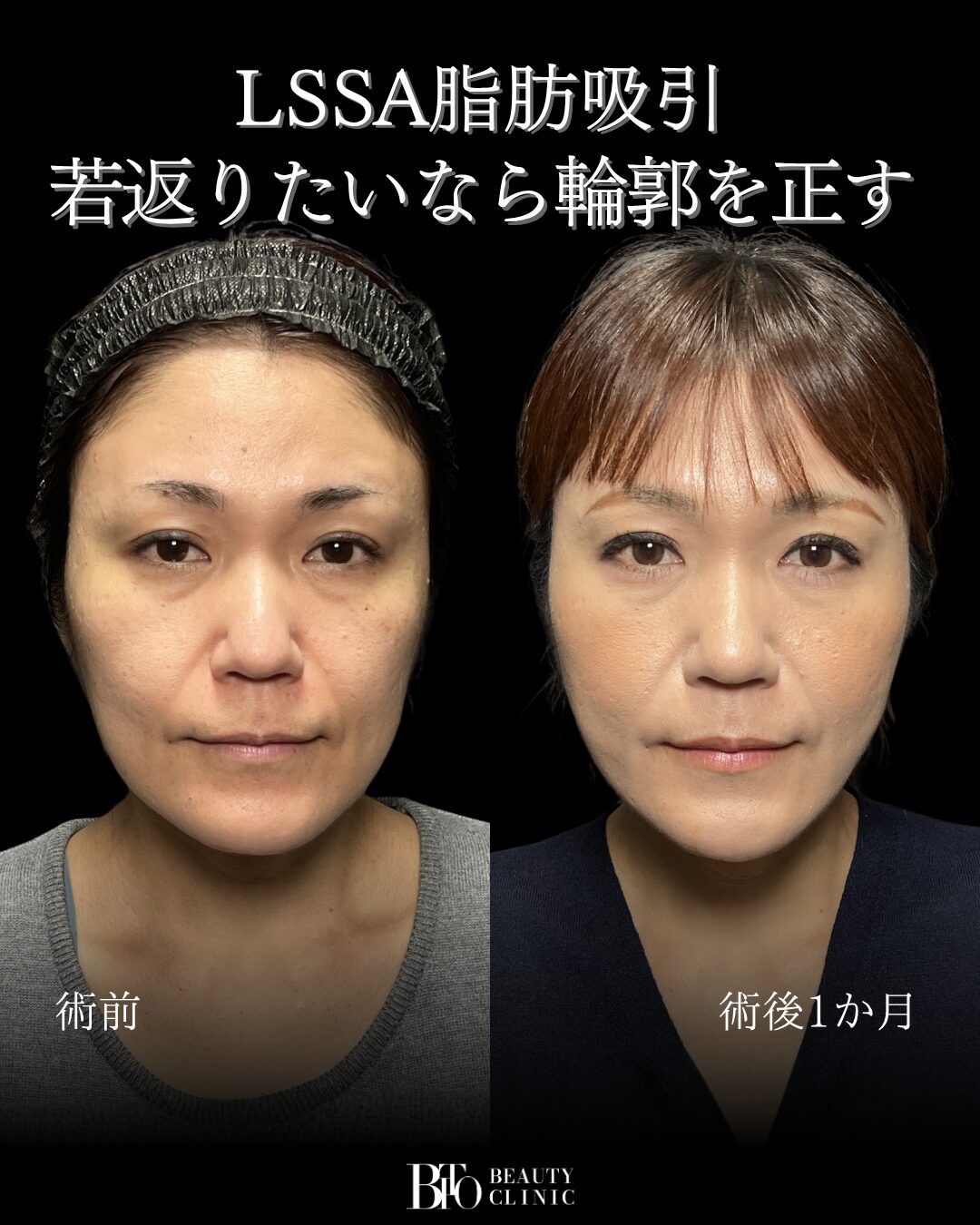 217.顔のLSSA脂肪吸引