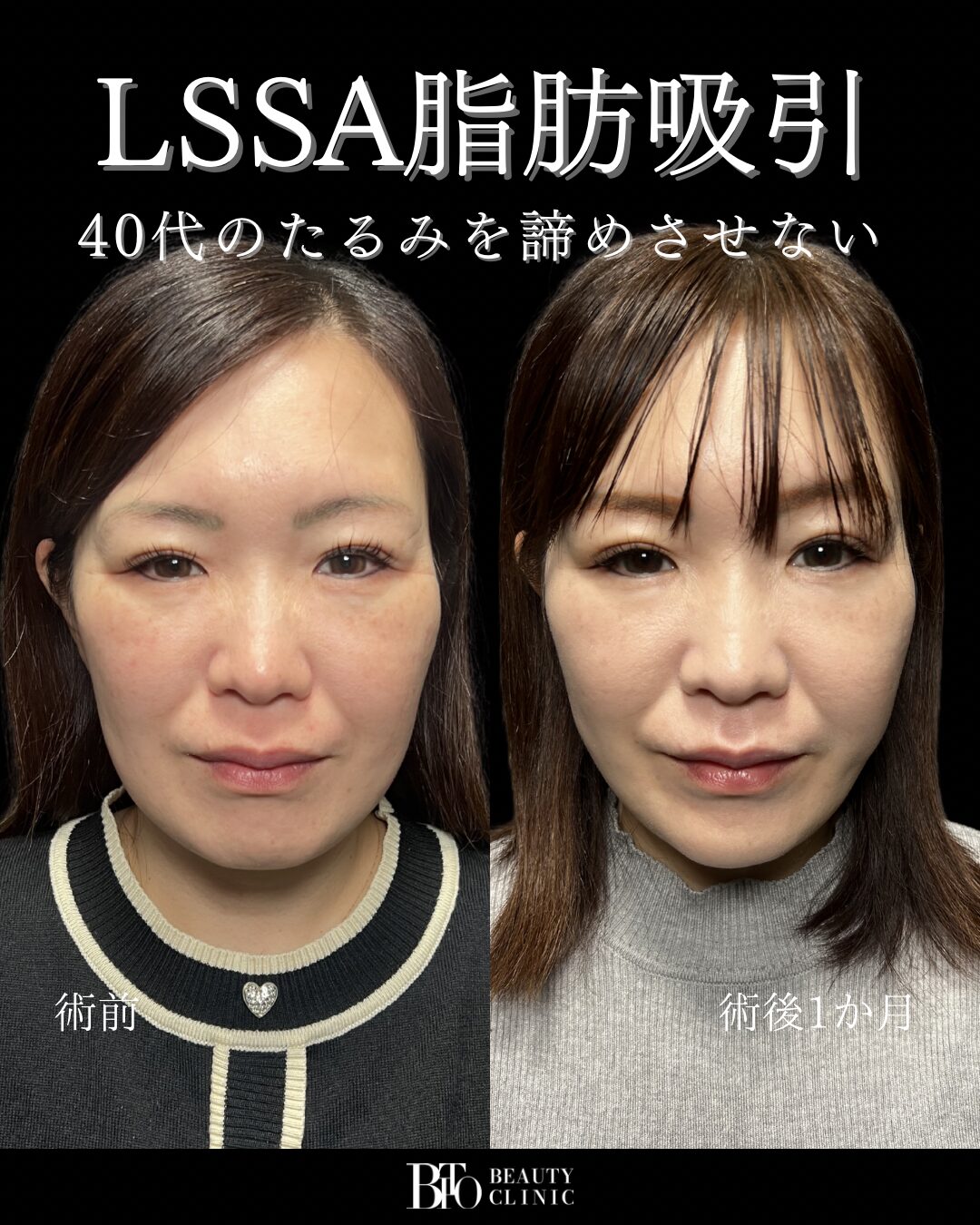 209.40代女性 顔のLSSA脂肪吸引