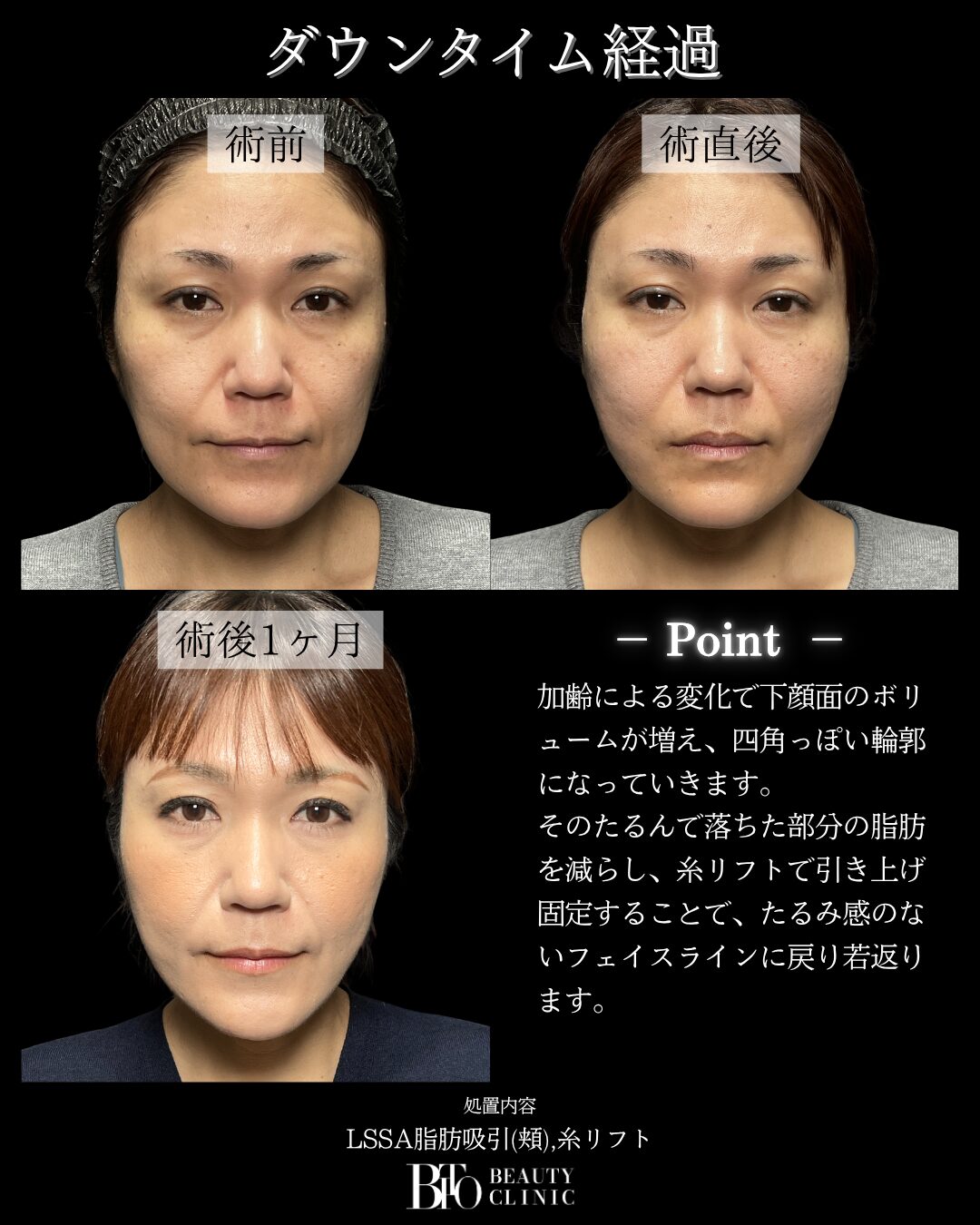 217.顔のLSSA脂肪吸引