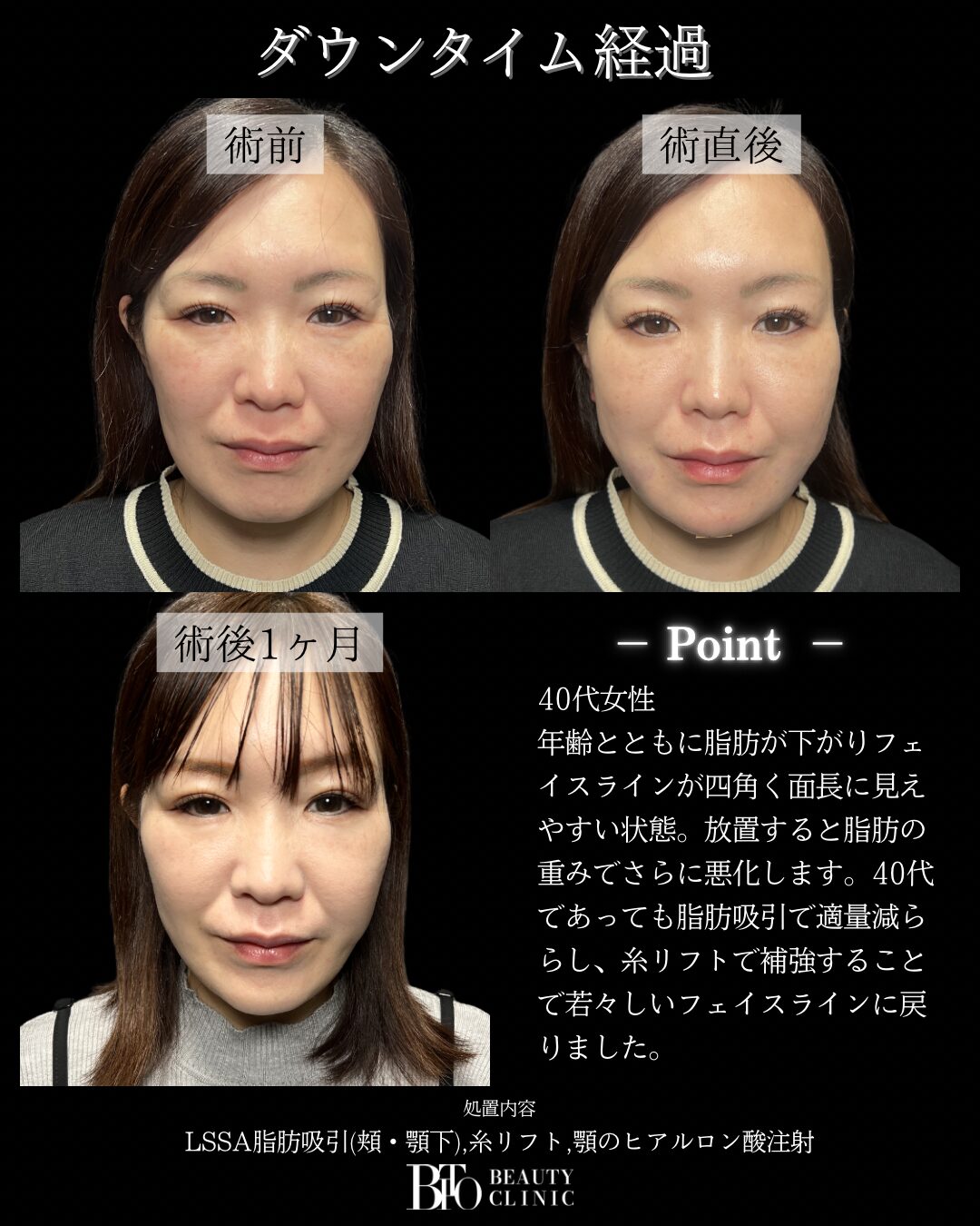 209.40代女性 顔のLSSA脂肪吸引
