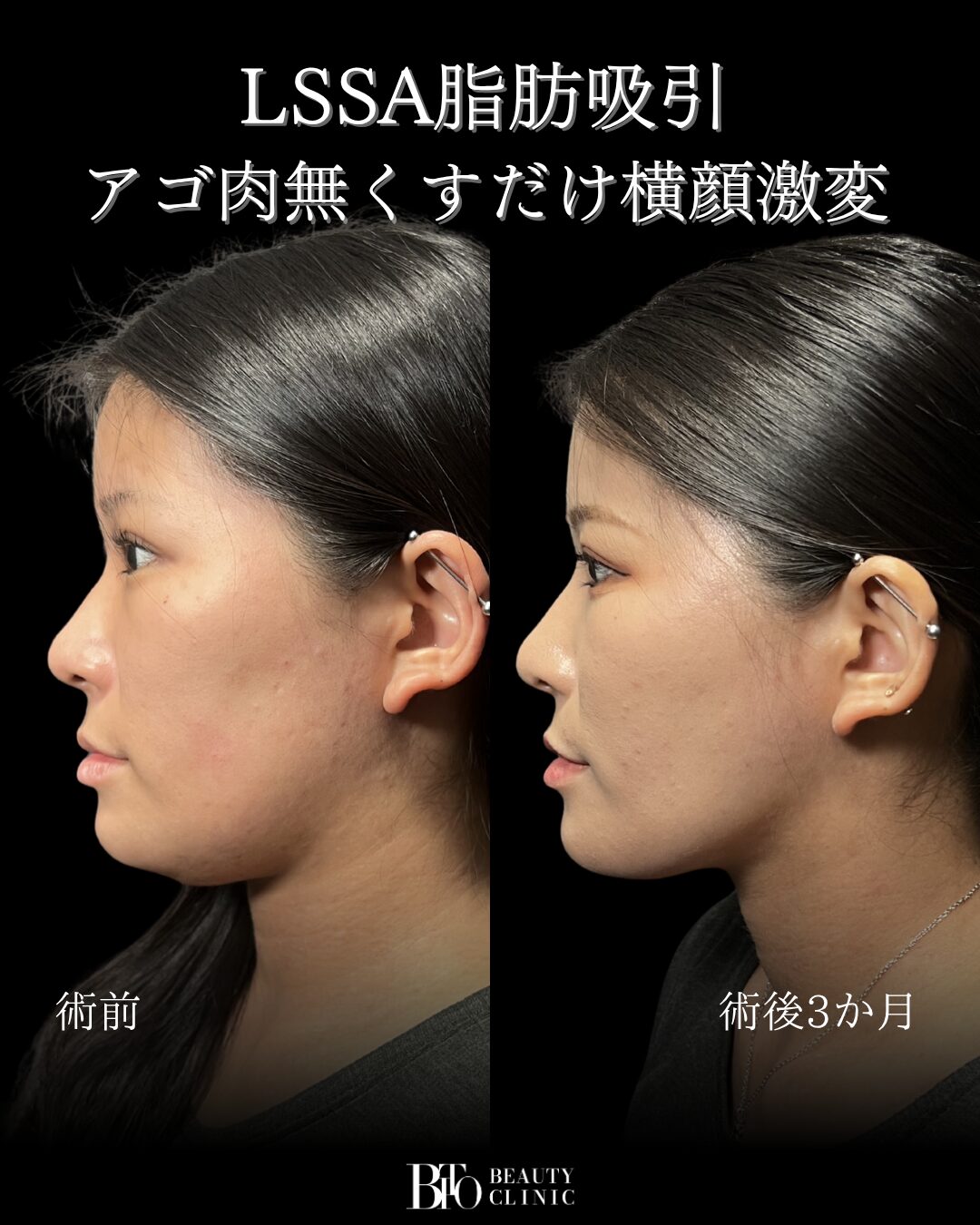 220.顔のLSSA脂肪吸引