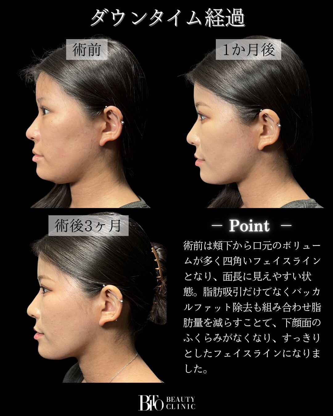 220.顔のLSSA脂肪吸引