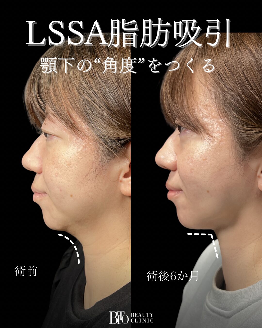 211.顔のLSSA脂肪吸引