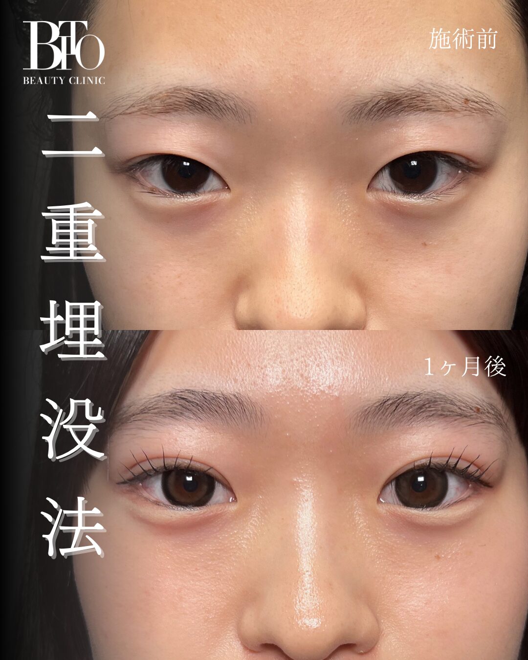 205.二重埋没法