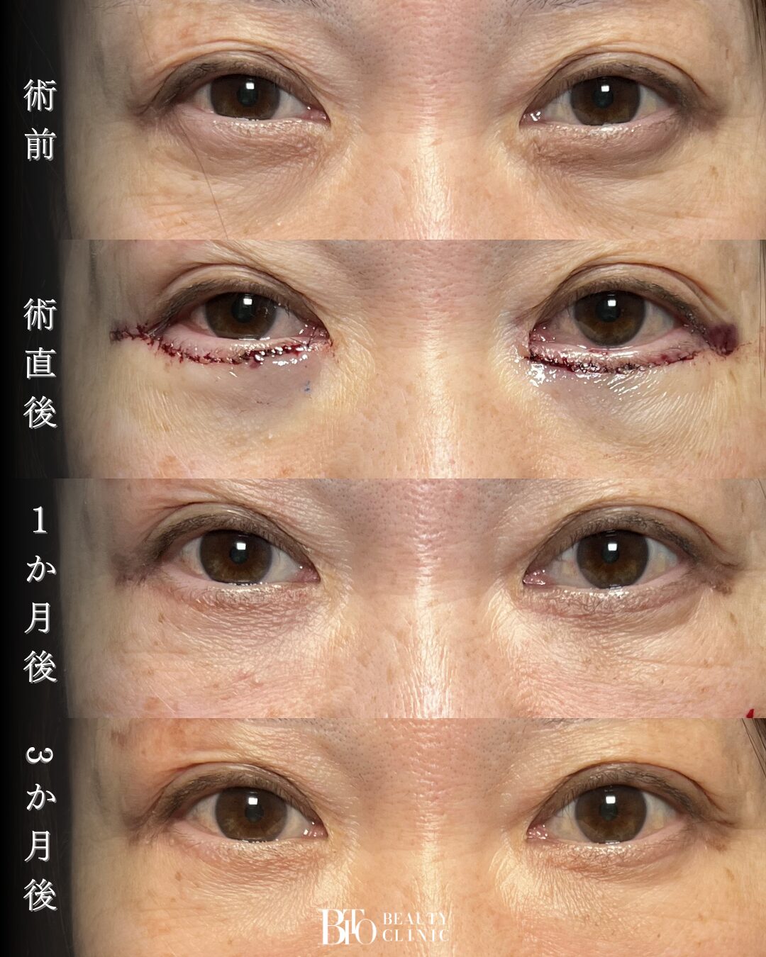 214.目の下のたるみ取り(除皺術)