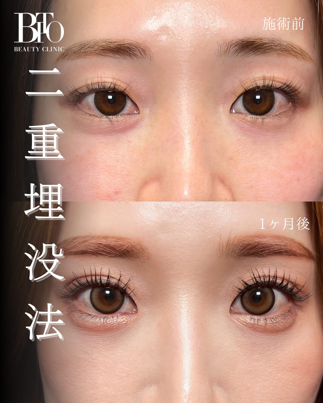 206.二重埋没法