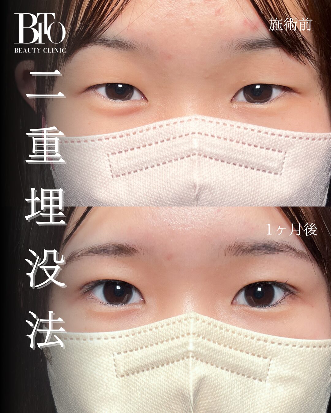 207.二重埋没法