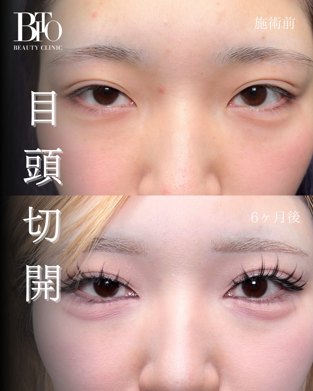 208.目頭切開