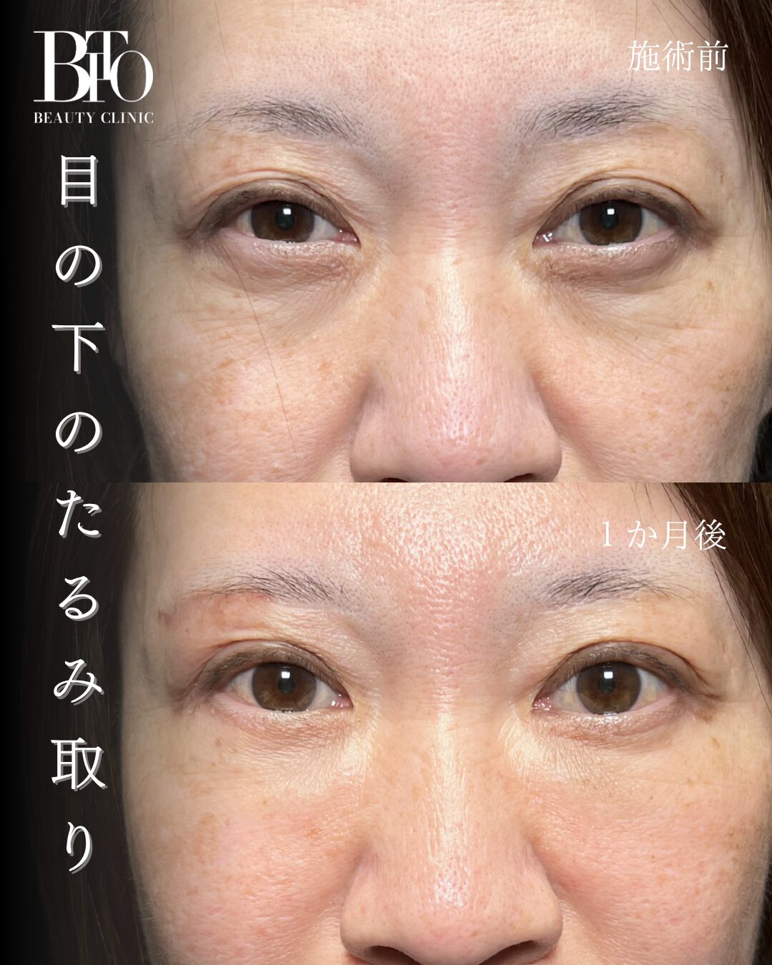 214.目の下のたるみ取り(除皺術)