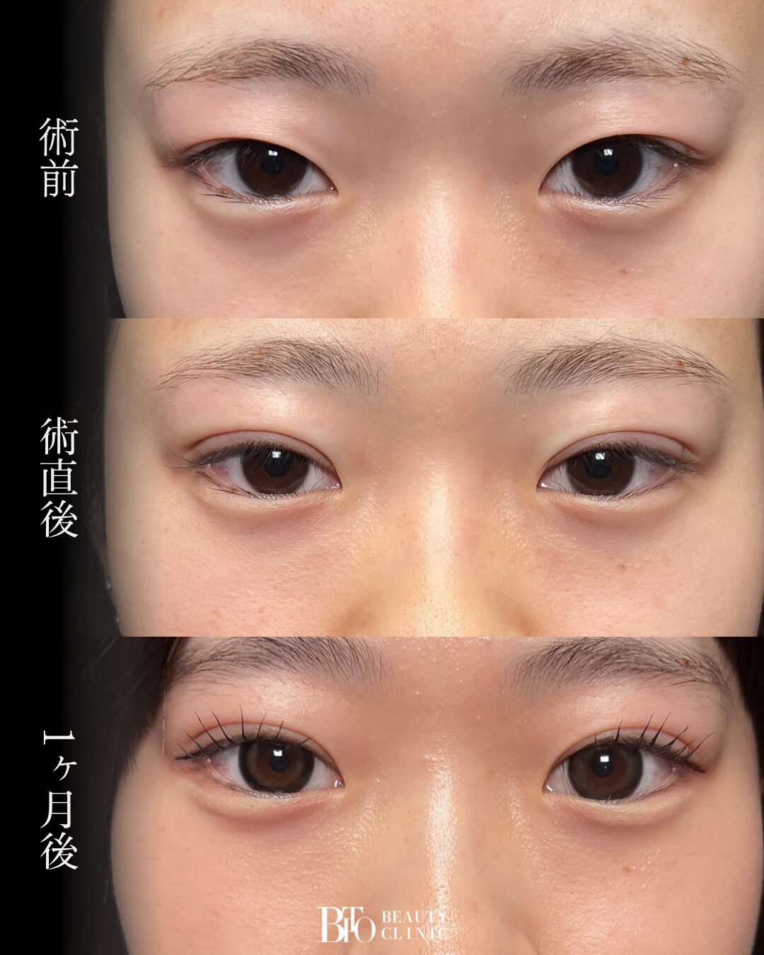205.二重埋没法