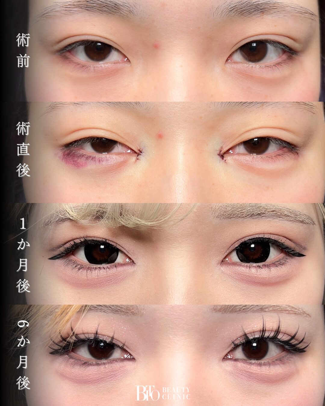 215.目頭切開