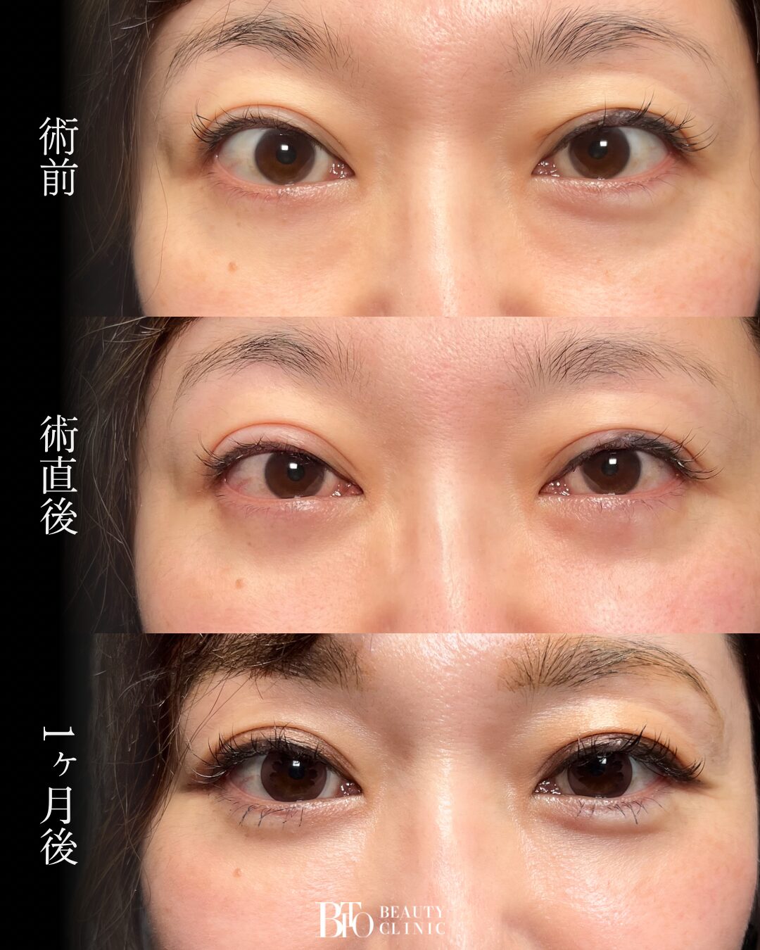 216.切らない目の下のクマ取り(脱脂術)