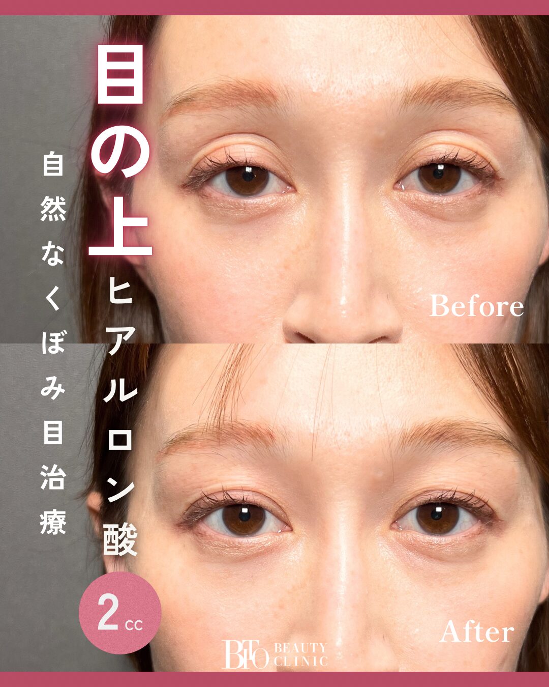 216.目の上のヒアルロン酸注入