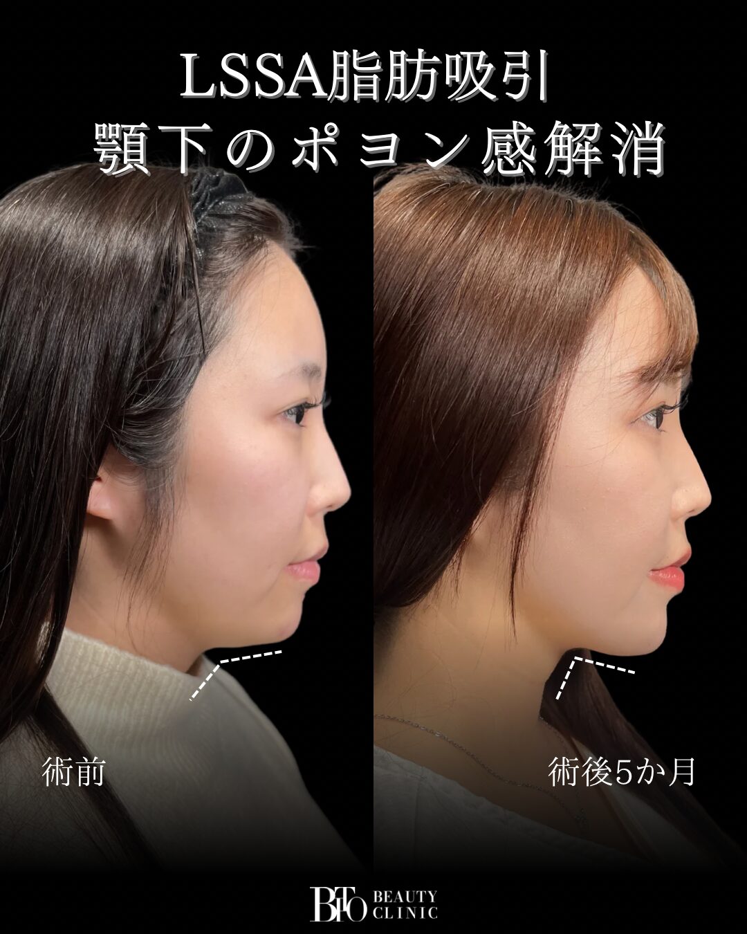 30代女性 顔のLSSA脂肪吸引