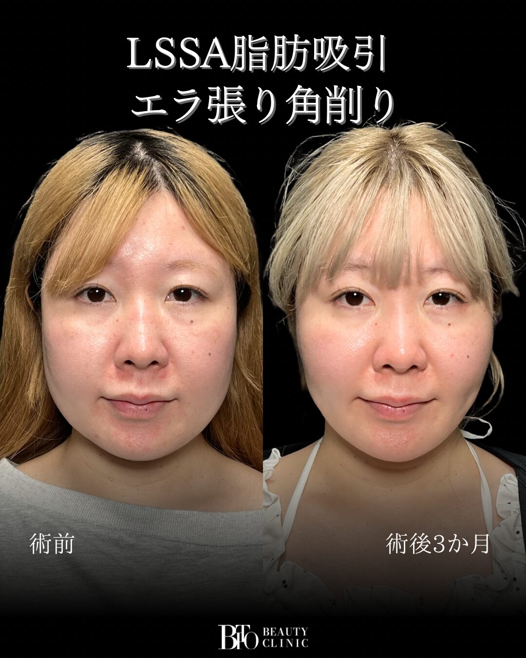 224.30代女性 顔のLSSA脂肪吸引