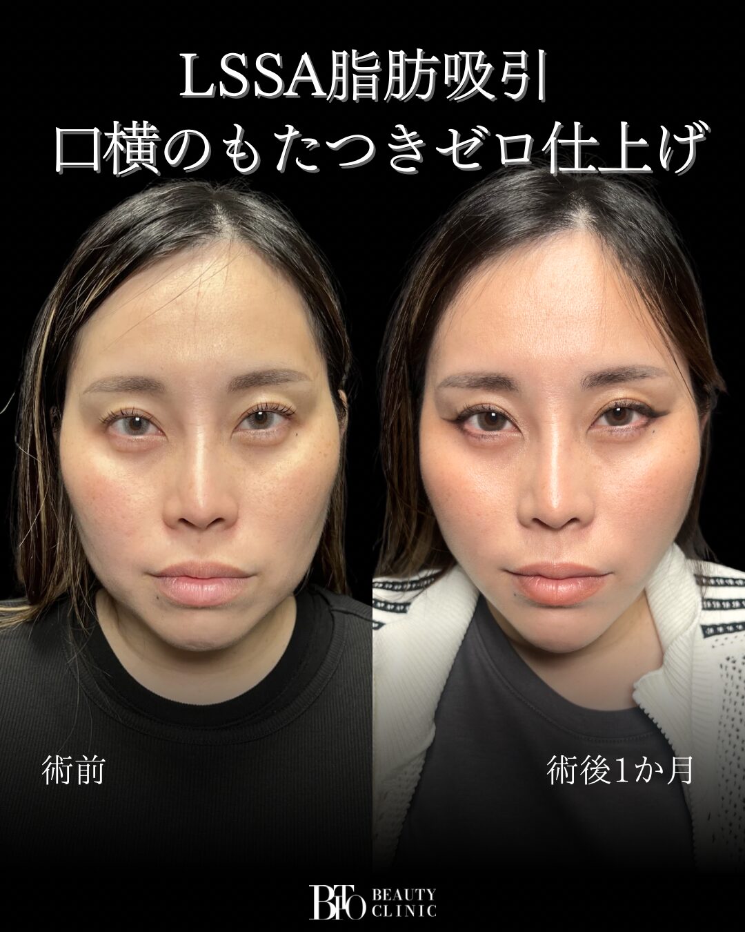 225.30代女性 顔のLSSA脂肪吸引
