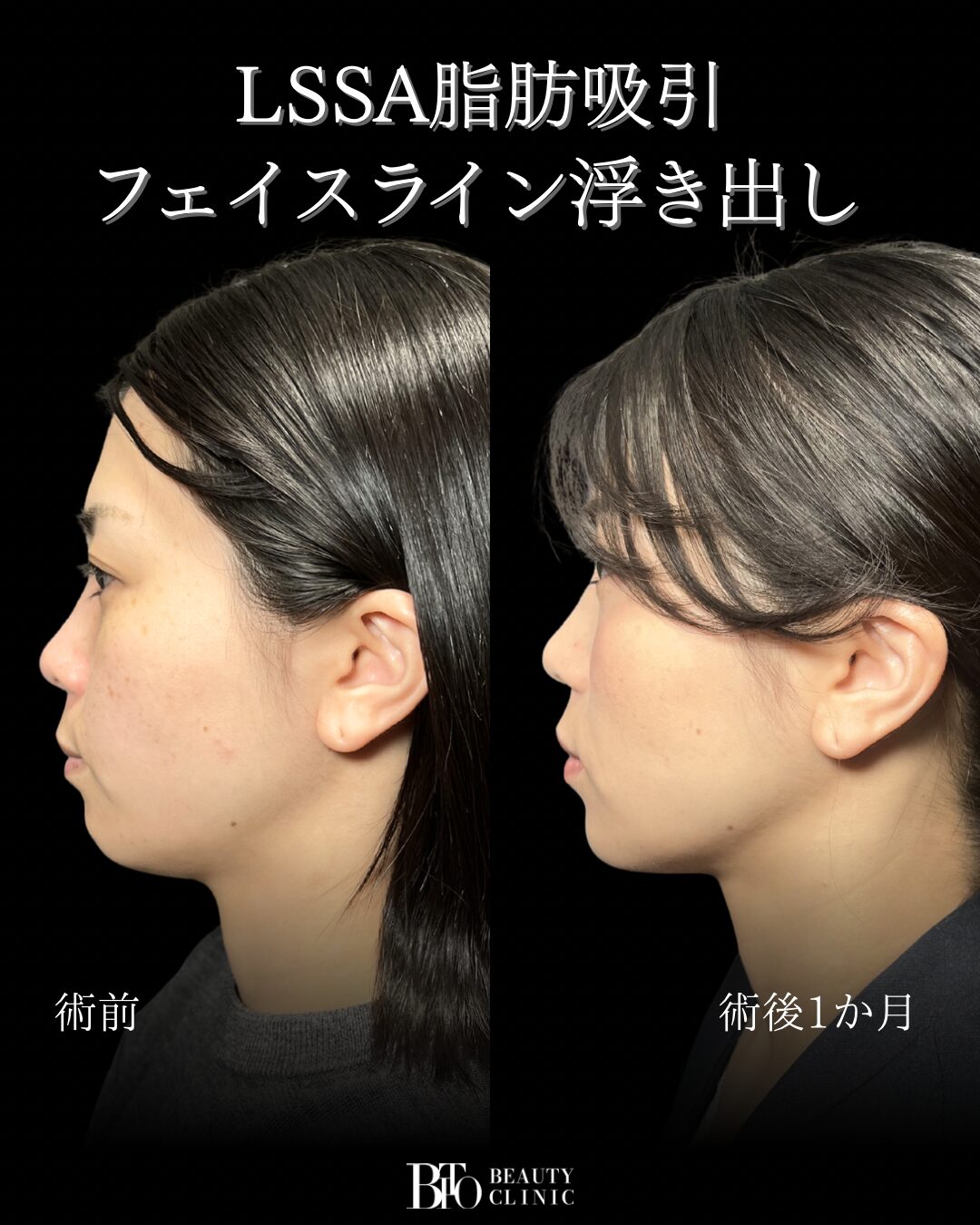 238.30代女性 顔のLSSA脂肪吸引