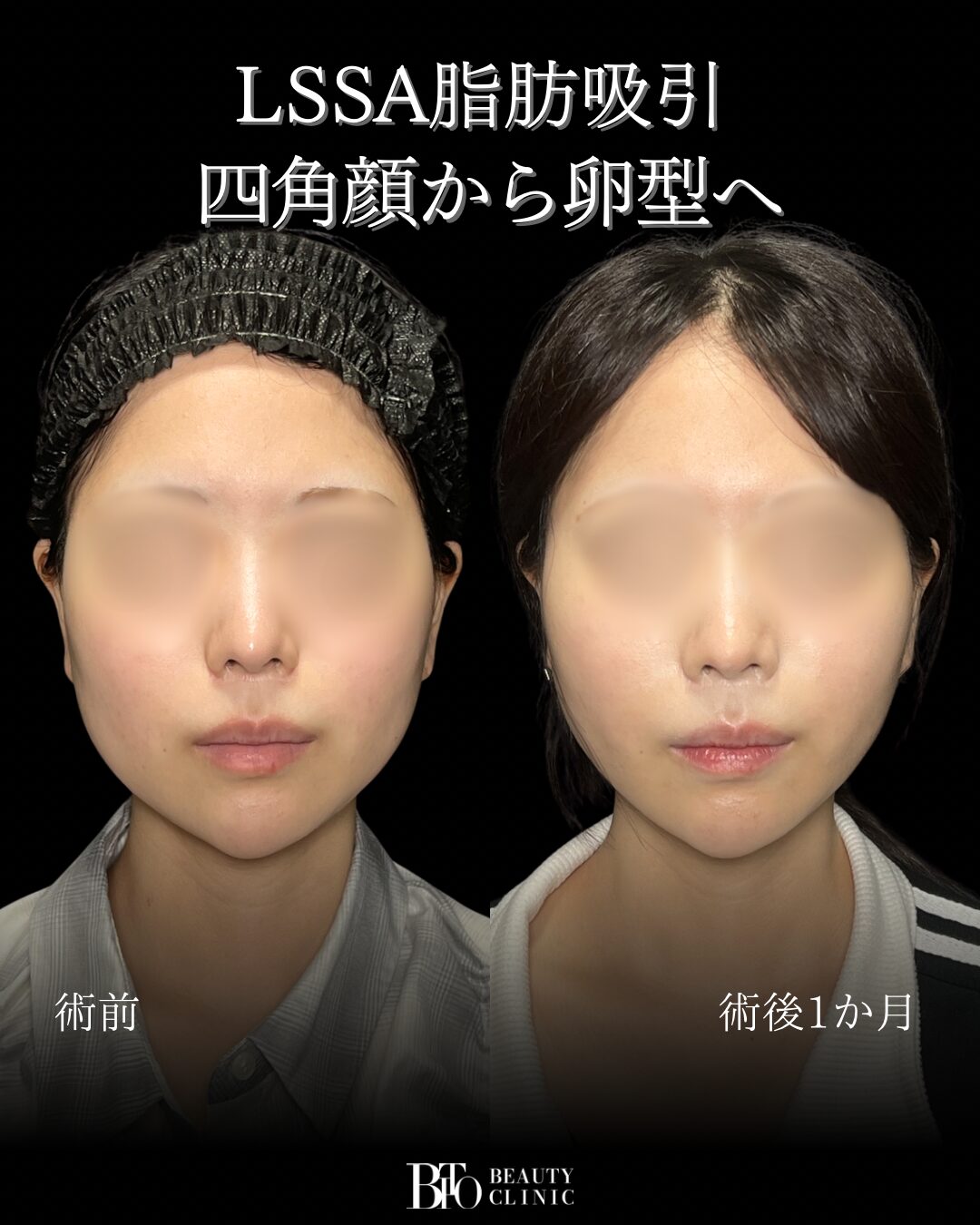 249.20代女性 顔のLSSA脂肪吸引