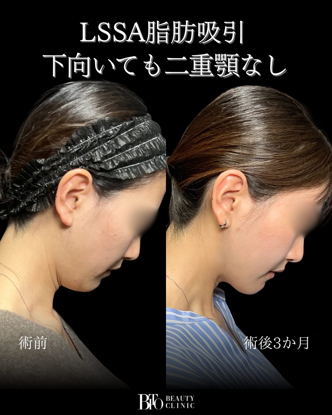 251.20代女性 顔のLSSA脂肪吸引