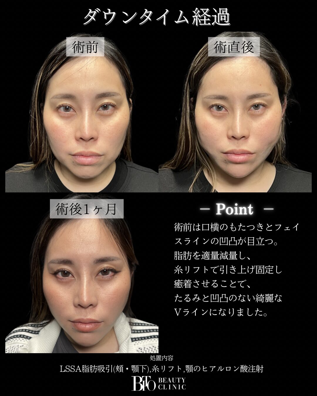 225.30代女性 顔のLSSA脂肪吸引