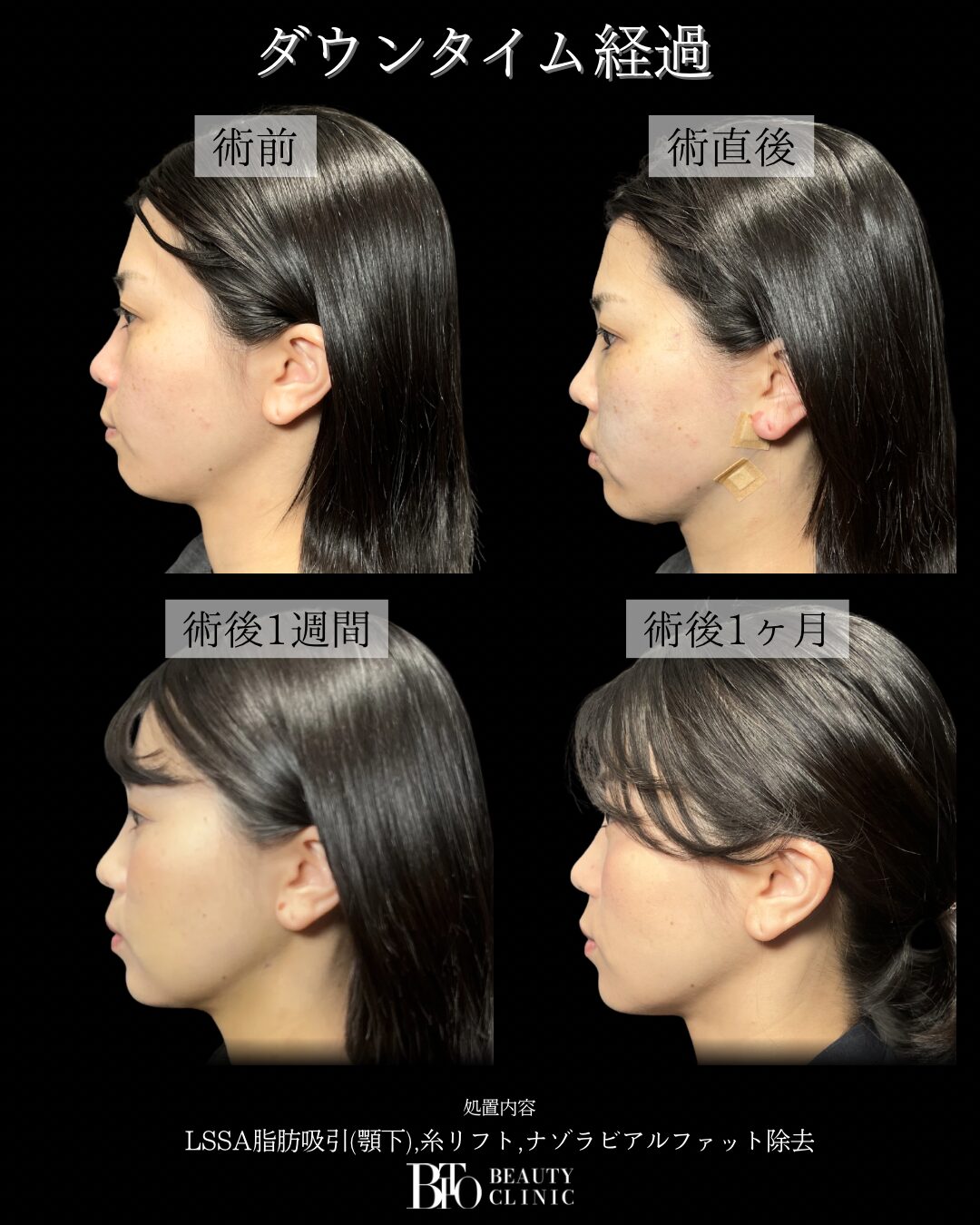 238.30代女性 顔のLSSA脂肪吸引