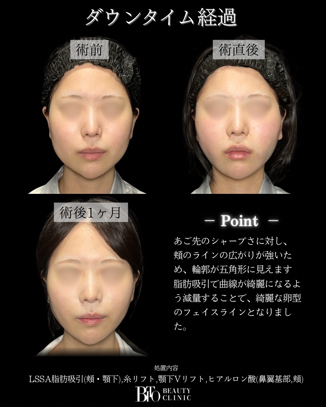 249.20代女性 顔のLSSA脂肪吸引