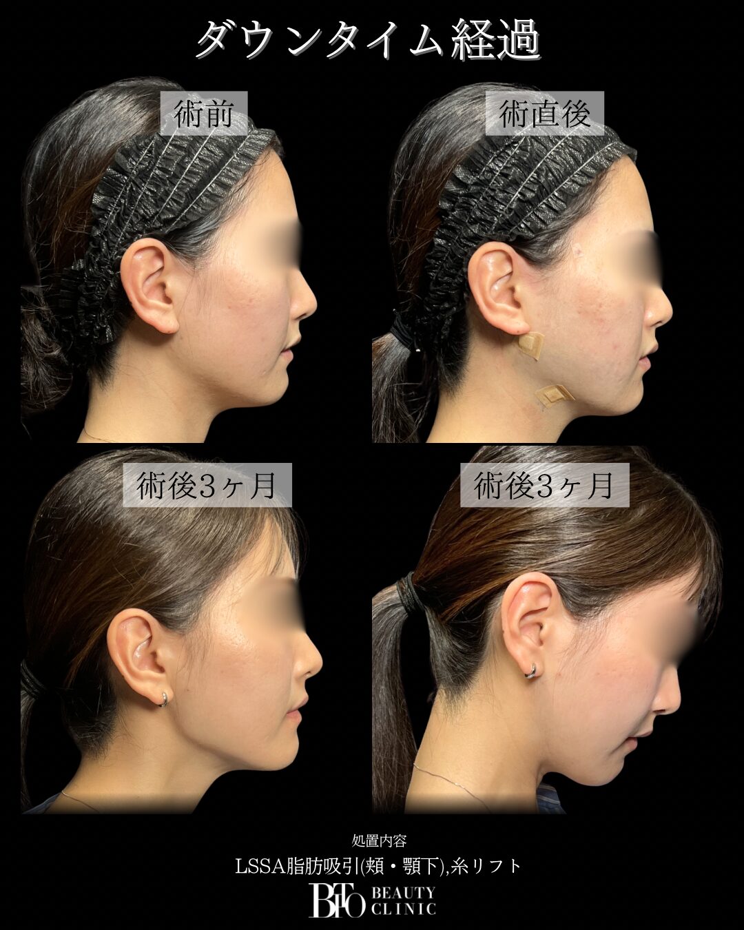 251.20代女性 顔のLSSA脂肪吸引
