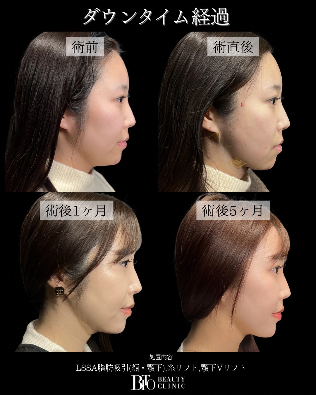 30代女性 顔のLSSA脂肪吸引
