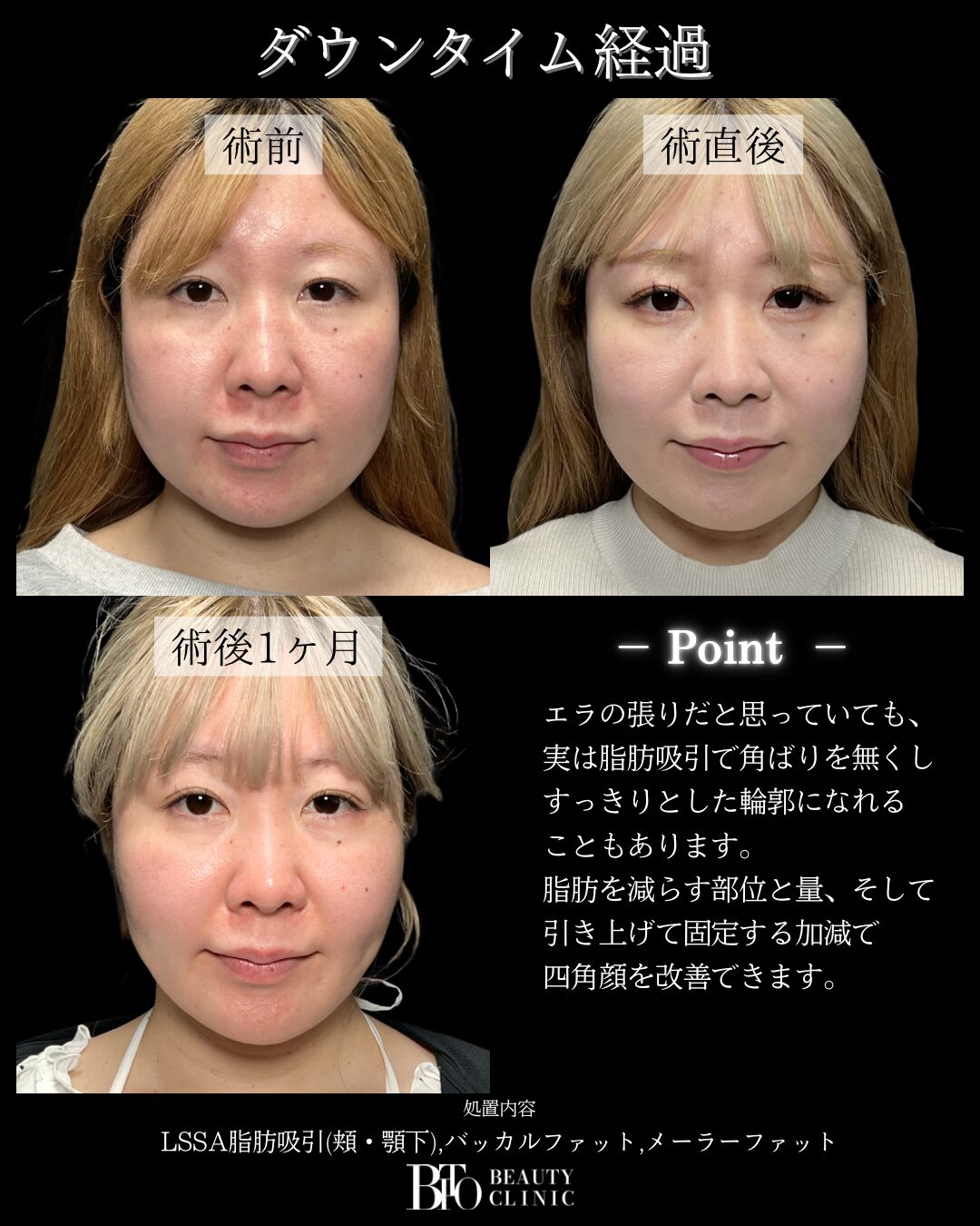 224.30代女性 顔のLSSA脂肪吸引
