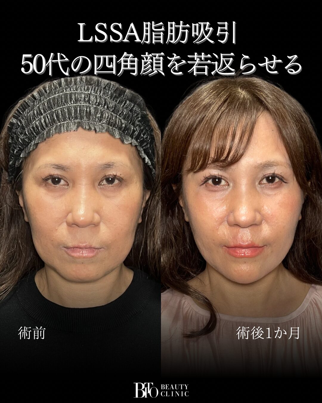 223.50代女性 顔のLSSA脂肪吸引