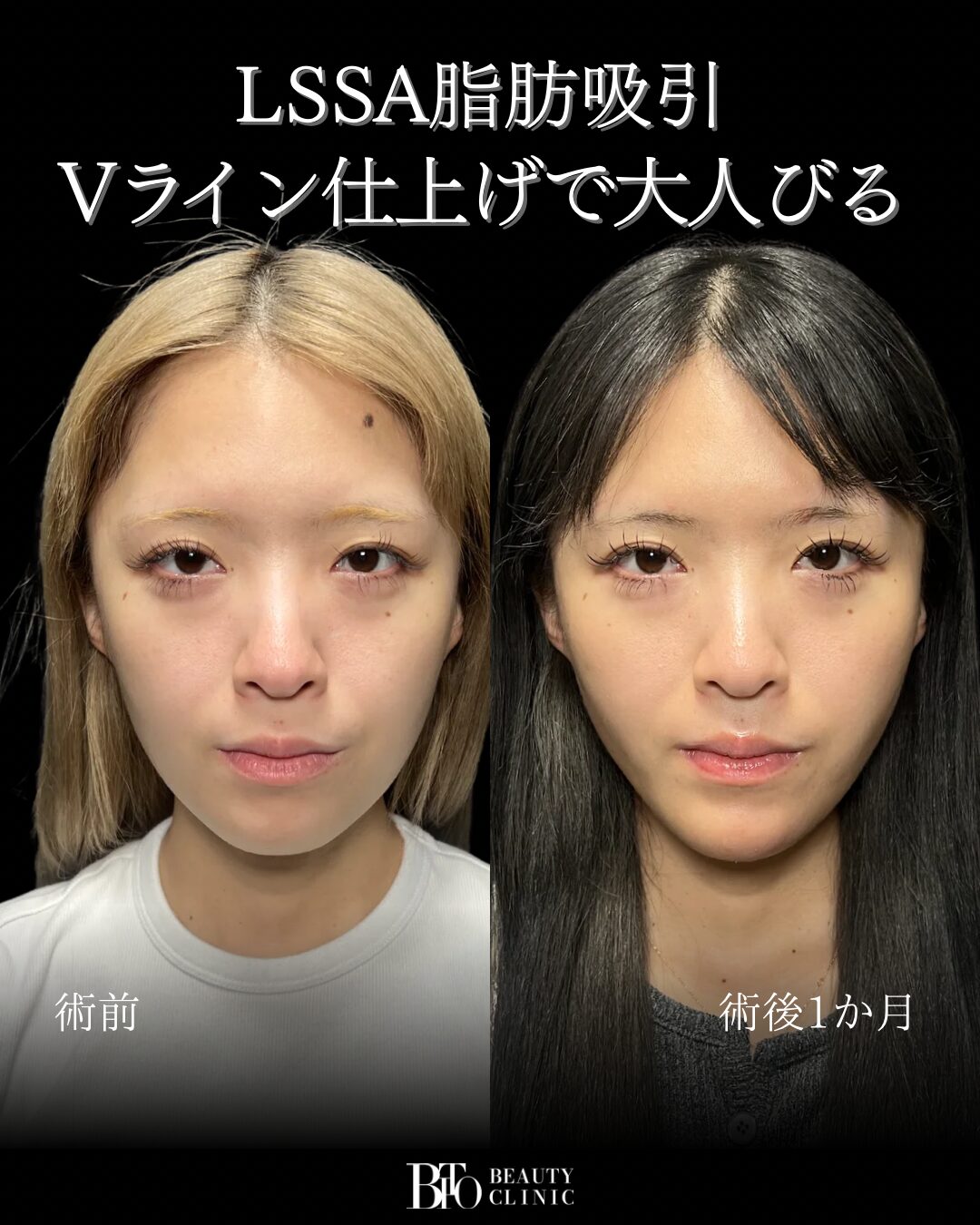 252.顔のLSSA脂肪吸引