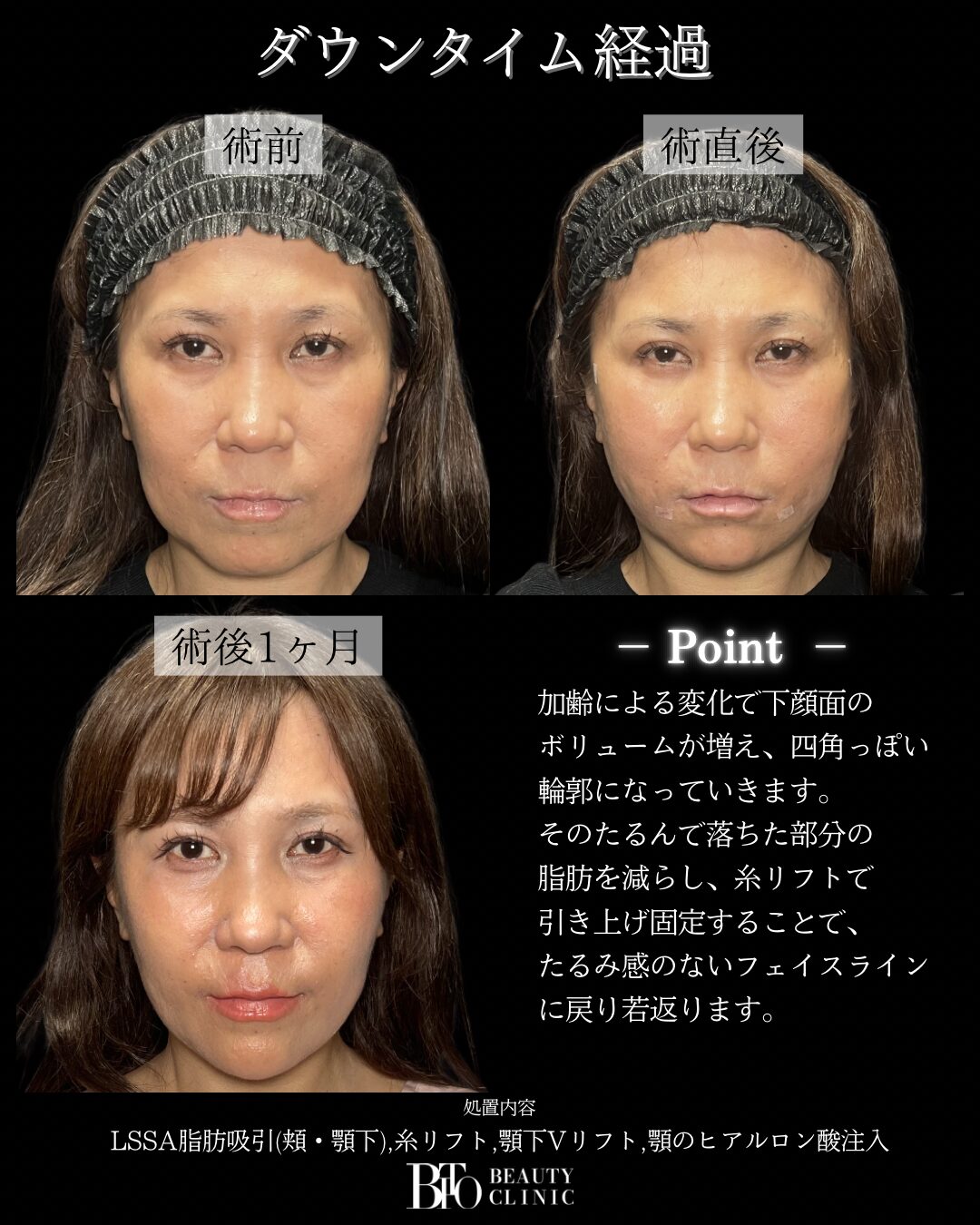223.50代女性 顔のLSSA脂肪吸引