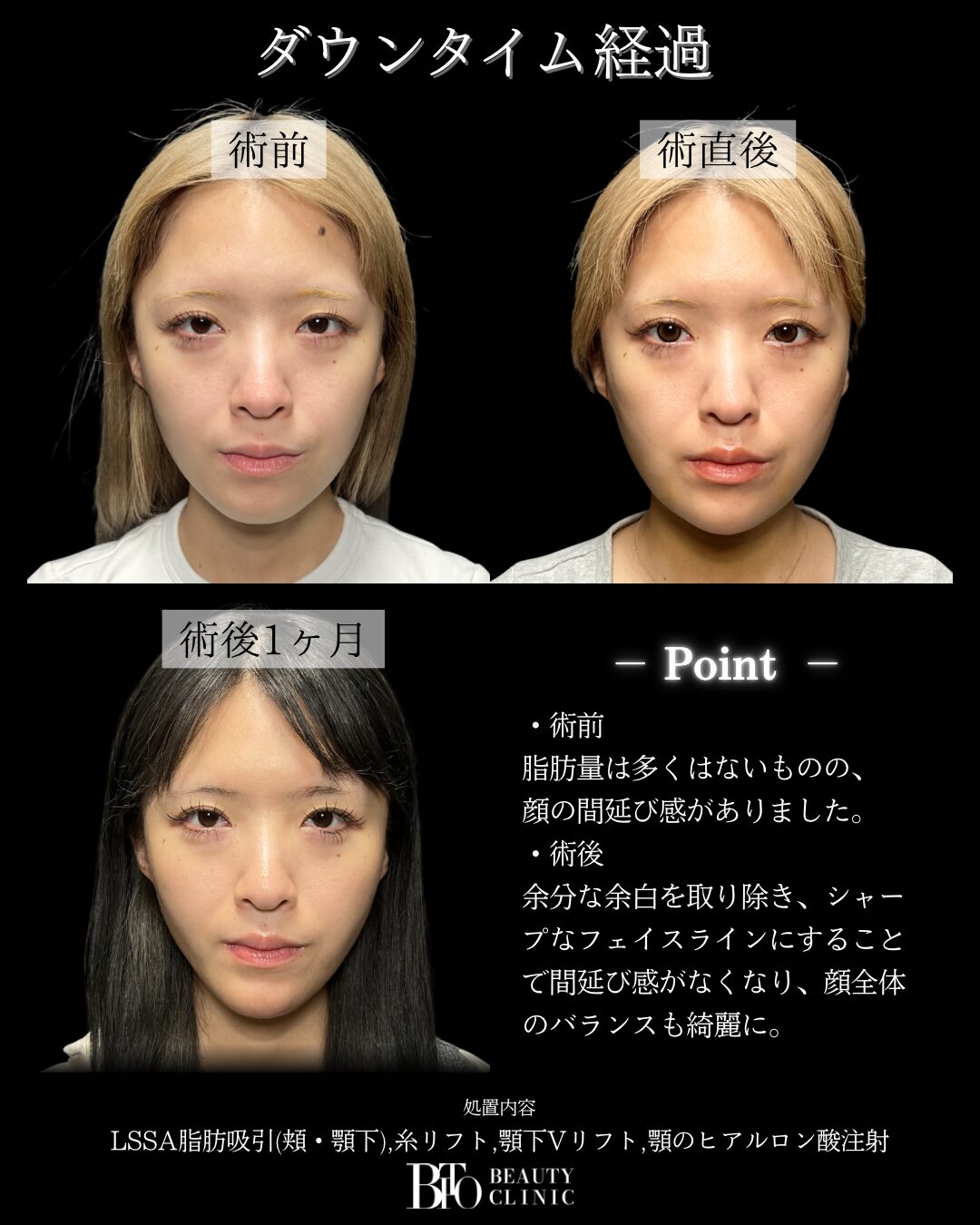 252.顔のLSSA脂肪吸引